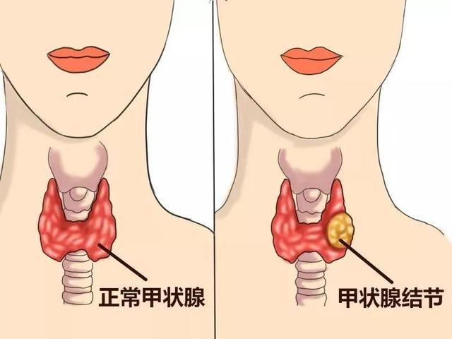 结节、息肉、增生，哪些“病块”会癌变？