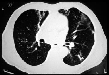 一文总结囊性纤维化的肺部影像学特征｜相“影”成趣