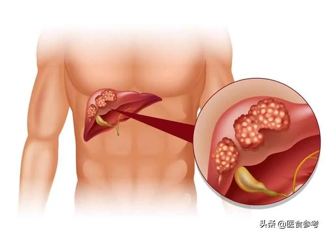 结节、息肉、囊肿、增生...哪个最可能癌变？这么多年疑惑终于解开了！