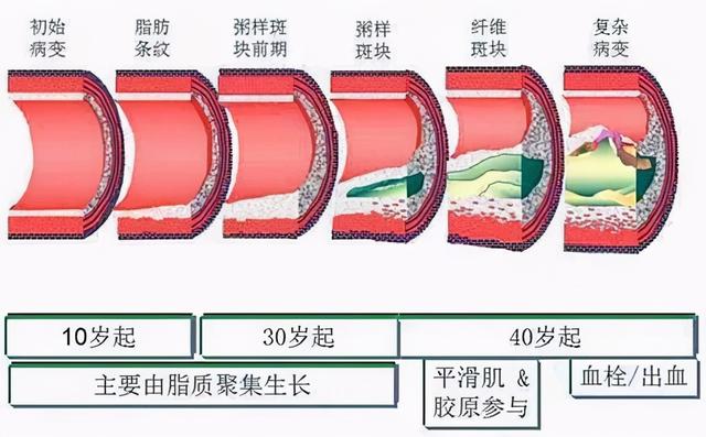 老年高血压，高压高，低压低，脉压差大，是病吗？是血管变硬吗？