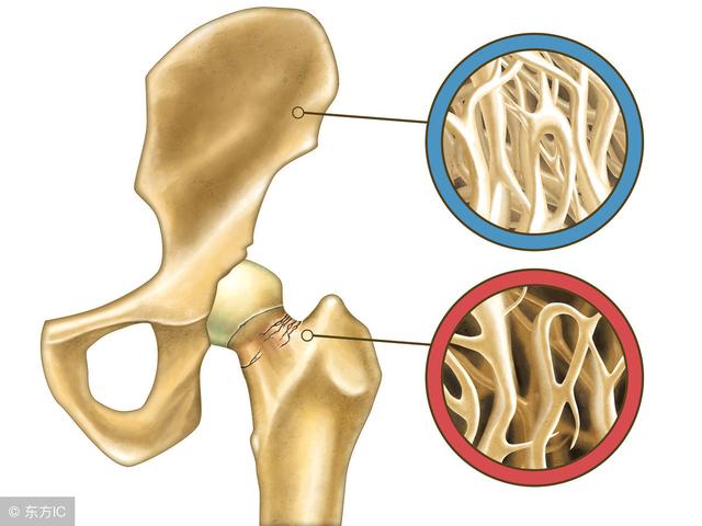 骨头|这个病，老百姓都以为是一个病，其实它只是人体的一个自我保护！