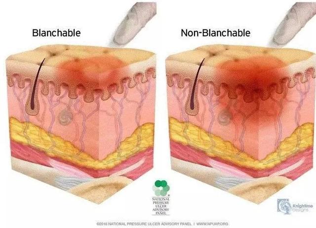 压疮情况要分期，严重危害需知道