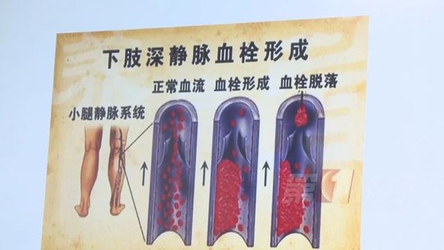 血栓|深圳一男子骨折险些猝死！医生：“动太少”...