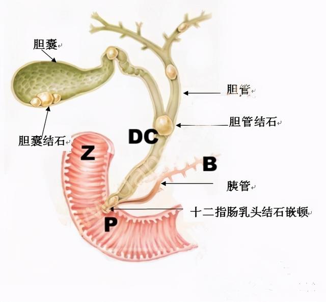 冬季结石高发，那么胆结石疼痛、不适该怎么办？