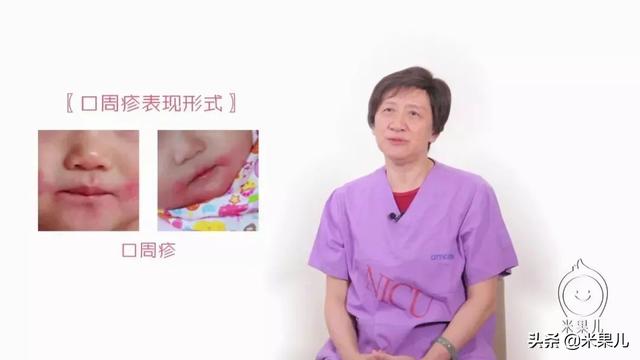 你的育儿经|宝宝嘴边长红疹,原来是这样引起的