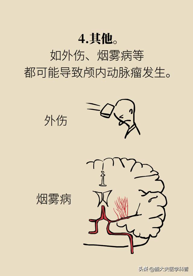 脑动脉瘤之一：脑动脉瘤是脑卒中吗？