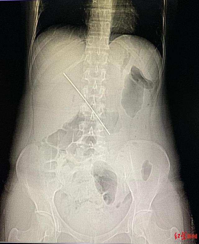 患者|女子腹痛难忍就医，CT检查发现体内竟有1