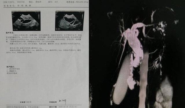 你的育儿经|2岁女孩经常肚子疼、呕吐……没想到是胆总管囊肿在作怪
