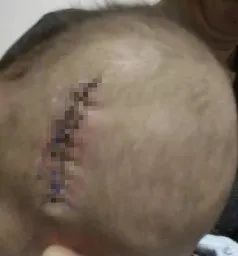 「暖先生格调」留置针管断裂在婴儿体内，一年多未找到！这种悲剧该如何避免？