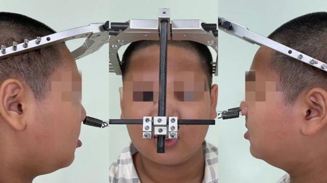 上颌骨|山东省首例！青岛妇儿医院成功开展上颌骨经颅缝外牵引术，让患儿重“绽”笑颜