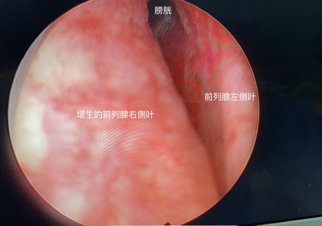 前列腺增生的五大常见误区，如何避坑？泌尿外科医生告诉你