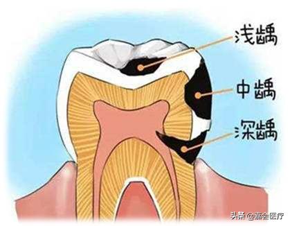 超级宝妈■当怀孕遇上牙疼,只能忍着吗?常见孕期口腔问题一文详解