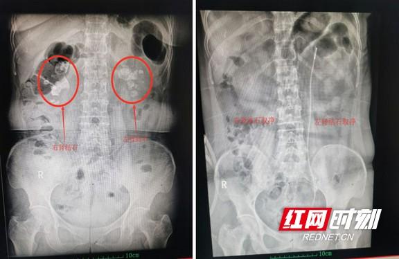 结石|结石引发重症感染医护携手攻坚克“石”助
