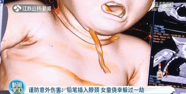 「你的育儿经」险！女童玩耍时铅笔插入脖子 离动脉仅0.01毫米