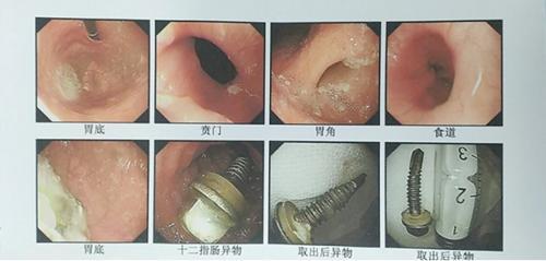 大河客户端▲家长吓坏了!两岁女童,吃了一根3厘米长的螺丝钉……