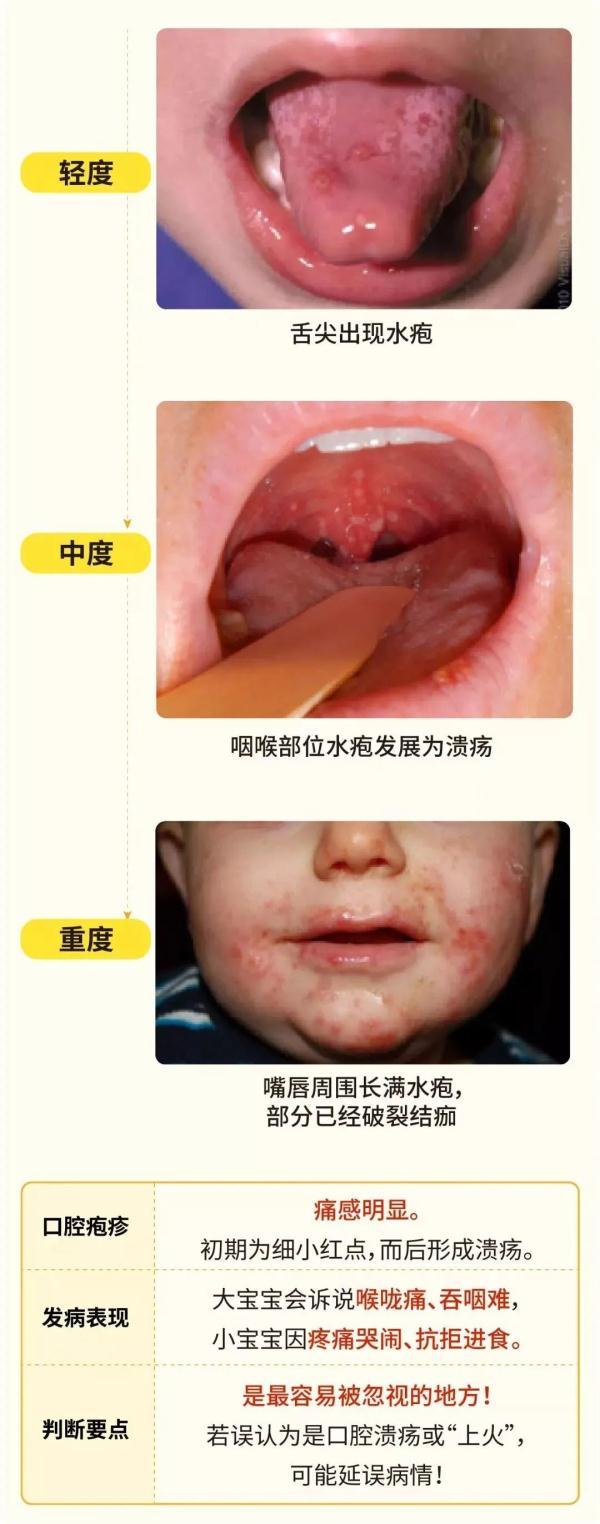手足|发现孩子手脚出现这种情况要当心了，这种无特效药的传染病正高发