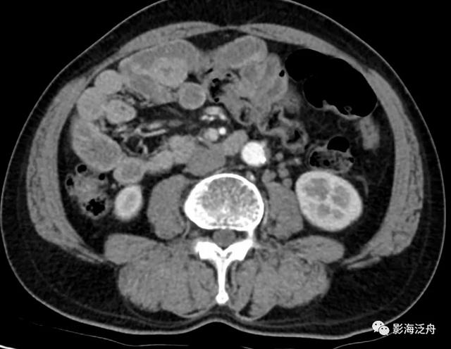这个病，腹部CT经常会漏诊