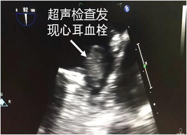 宝山首例ICE指导下房颤“一站式”介入治疗在仁济医院宝山分院成功开展