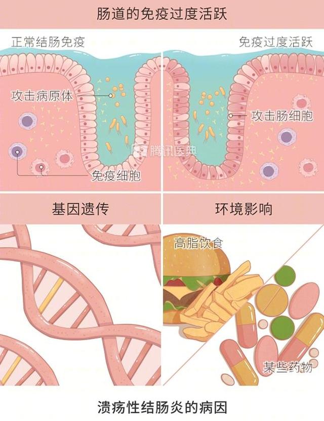 27岁小伙肠穿孔无人敢收治，术后2年流黄水，只因这个习惯