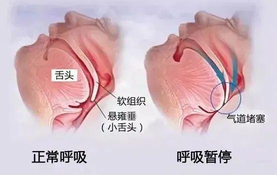 呼吸|打呼噜，打打停停最可怕
