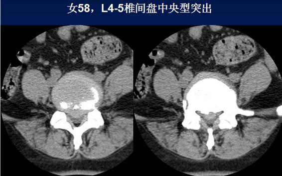 腰椎间盘CT诊断：椎间盘膨出、突出、椎管狭窄及退行性病变