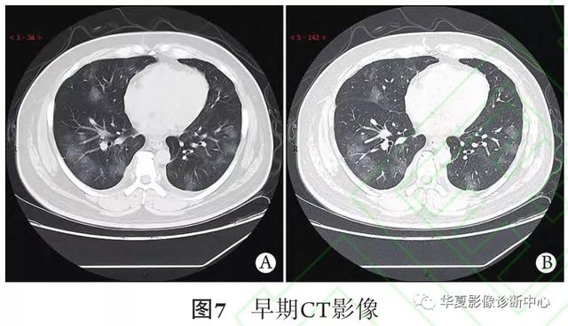 「影像进展」新冠肺炎的CT典型和不典型表现以及影像学分期