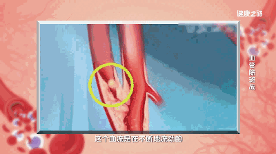 心梗要命，脑梗要瘫！血管堵住多少就要进行手术干预？