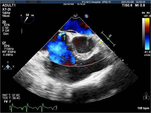 卵圆孔|攻坚克难｜青年脑梗死竟因心脏有个“洞