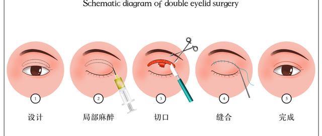 双眼皮|春节假期来临，双眼皮手术了解一下？