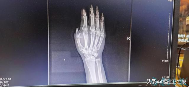 再造|福州一女工右手拇指不慎被机器绞断，医生“移花接木”脚趾变手指