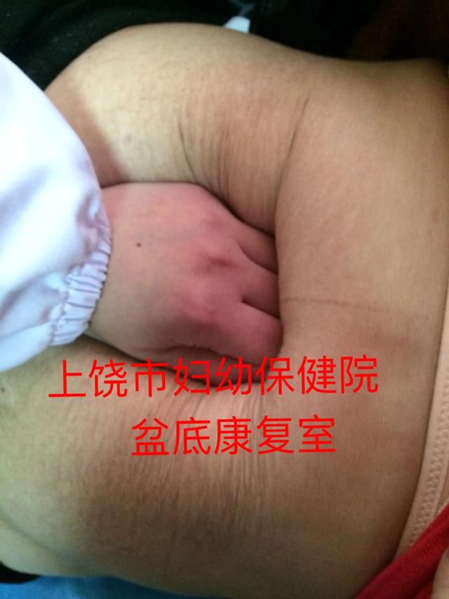你的育儿经■【女性健康】高龄产妇产后腹直肌严重分离，在家该如何自测恢复？
