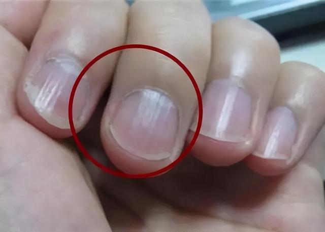 为什么很多人指甲上有月牙，有的人却一个都没有？科学解释来了