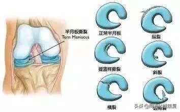 身体不可再生资源——半月板的康复之路