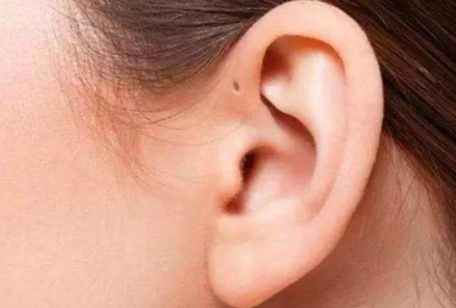 为啥有些新生儿耳边有“小孔”？医生不会主动说，家长心里要有数