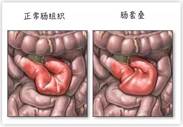 [夕阳下的彩虹]截掉20厘米肠子，娃才保住命！3岁内高发请注意！