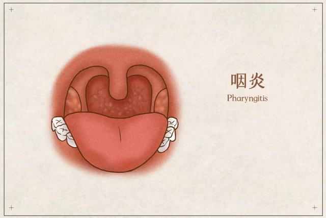 让你“如鲠在喉”的慢性咽炎，日常如何护理？