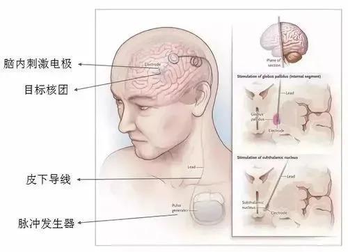 帕金森病DBS手术的有效性、时机及风险预判