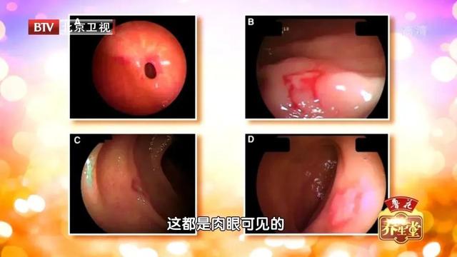 阿司匹林|这类人群，吃阿司匹林可能很危险！做好一件事，脑出血早早早发现