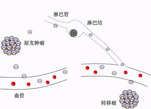 癌细胞会转移吗？我想你很有必要应该知道；特别是癌变患者