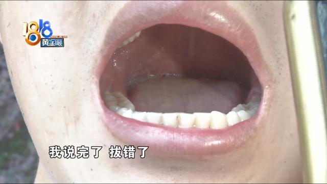 牙齿|想拔左侧智齿，医生为何拔了右边？
