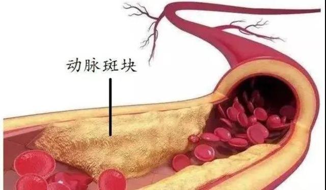 潍坊市中医院斑块旋切技术还原下肢血管自然腔道，让血管更通畅