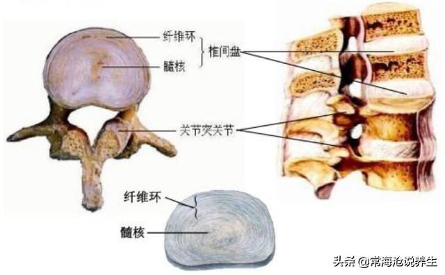 纤维环|还在被腰椎间盘疾病困扰？3种不同腰椎问题，别再傻傻分不清