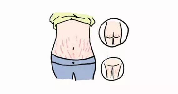 亲亲一家人|节食瘦了之后的妊娠纹怎么消除？这个方法，健康安全
