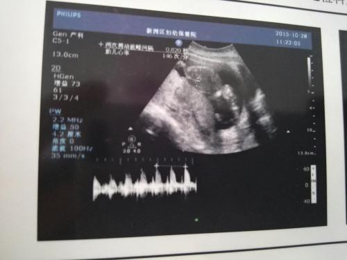 「你的育儿经」女子“怀孕”3个月，B超显示腹中没有胎儿，孕妇大哭医生却笑了