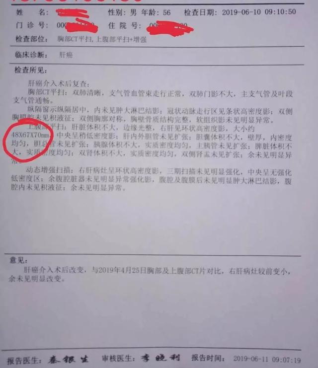 中药治肝癌肿瘤，一疗程后肿瘤开始缩小