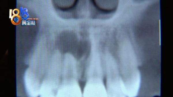 小杜|拍片没发现“囊肿”，四颗牙要缺一年？