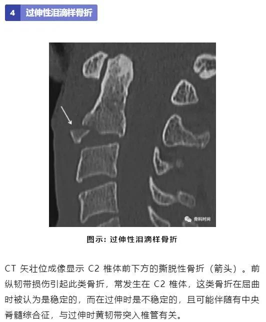 影像经验！脊柱的 13 个影像学特征