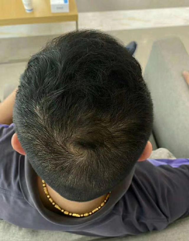 非那雄胺的真实有效率是多少（五位发友改善一年，终于告别稀疏）