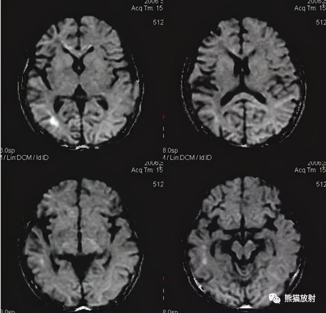 烟雾病的CT及MRI诊断