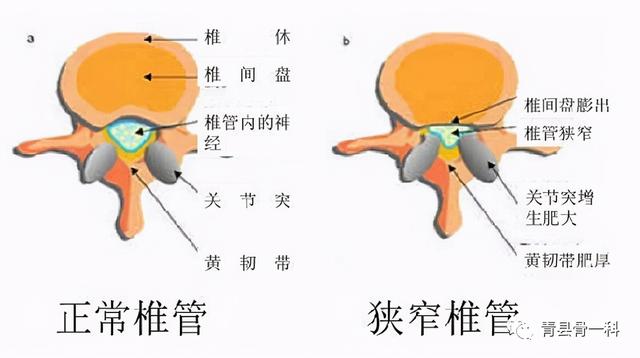 间接性跛行是腰椎椎管狭窄的症状